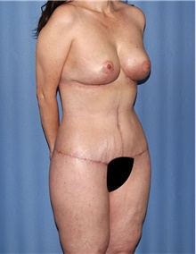 Body Contouring After Photo by Siamak Agha, MD PhD FACS; ,  - Case 43997