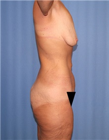 Body Contouring Before Photo by Siamak Agha, MD PhD FACS; ,  - Case 44000