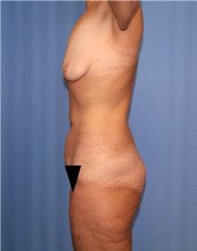 Body Contouring Before Photo by Siamak Agha, MD PhD FACS; ,  - Case 44000