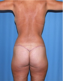 Body Contouring After Photo by Siamak Agha, MD PhD FACS; ,  - Case 44000