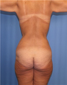 Body Contouring Before Photo by Siamak Agha, MD PhD FACS; ,  - Case 44000
