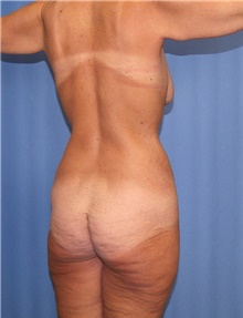 Body Contouring Before Photo by Siamak Agha, MD PhD FACS; ,  - Case 44000