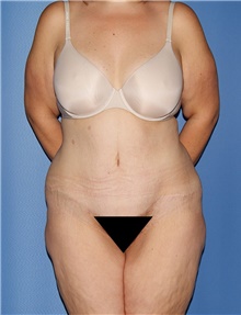 Body Contouring Before Photo by Siamak Agha, MD PhD FACS; ,  - Case 44003
