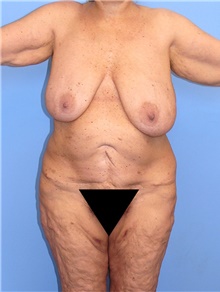 Body Contouring Before Photo by Siamak Agha, MD PhD FACS; ,  - Case 44011
