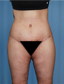 Body Contouring After Photo by Siamak Agha, MD PhD FACS; ,  - Case 44038