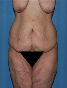 Body Contouring Before Photo by Siamak Agha, MD PhD FACS; ,  - Case 44038