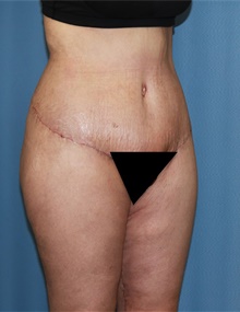 Body Contouring After Photo by Siamak Agha, MD PhD FACS; ,  - Case 44038