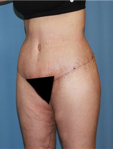 Body Contouring After Photo by Siamak Agha, MD PhD FACS; ,  - Case 44038