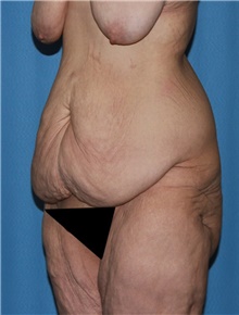 Body Contouring Before Photo by Siamak Agha, MD PhD FACS; ,  - Case 44038