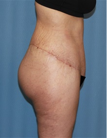 Body Contouring After Photo by Siamak Agha, MD PhD FACS; ,  - Case 44038