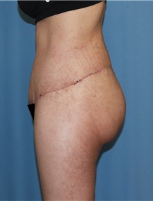 Body Contouring After Photo by Siamak Agha, MD PhD FACS; ,  - Case 44038