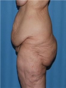 Body Contouring Before Photo by Siamak Agha, MD PhD FACS; ,  - Case 44038