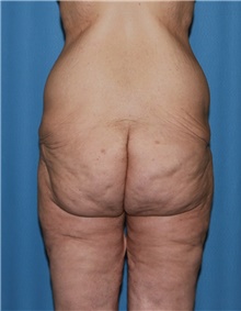 Body Contouring Before Photo by Siamak Agha, MD PhD FACS; ,  - Case 44038