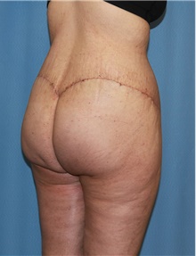 Body Contouring After Photo by Siamak Agha, MD PhD FACS; ,  - Case 44038