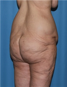 Body Contouring Before Photo by Siamak Agha, MD PhD FACS; ,  - Case 44038