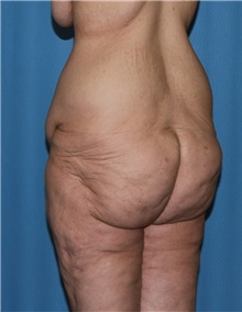 Body Contouring Before Photo by Siamak Agha, MD PhD FACS; ,  - Case 44038
