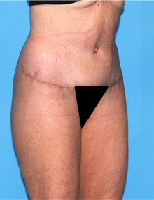 Body Contouring After Photo by Siamak Agha, MD PhD FACS; ,  - Case 44070