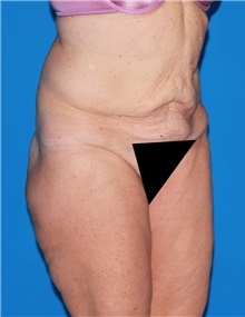 Body Contouring Before Photo by Siamak Agha, MD PhD FACS; ,  - Case 44070