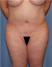 Body Contouring Before Photo by Siamak Agha, MD PhD FACS; ,  - Case 44101