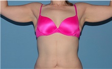 Arm Lift Before Photo by Siamak Agha, MD PhD FACS; ,  - Case 44114