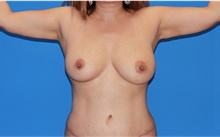 Arm Lift After Photo by Siamak Agha, MD PhD FACS; ,  - Case 44115