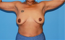 Arm Lift After Photo by Siamak Agha, MD PhD FACS; ,  - Case 44119
