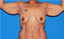 Arm Lift Before Photo by Siamak Agha, MD PhD FACS; ,  - Case 44119