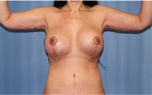 Arm Lift After Photo by Siamak Agha, MD PhD FACS; ,  - Case 44137