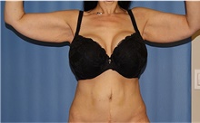 Arm Lift Before Photo by Siamak Agha, MD PhD FACS; ,  - Case 44137