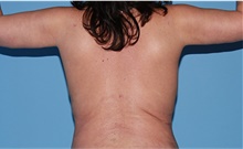 Body Contouring After Photo by Siamak Agha, MD PhD FACS; ,  - Case 44141
