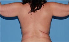 Body Contouring Before Photo by Siamak Agha, MD PhD FACS; ,  - Case 44141