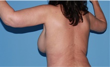 Body Contouring After Photo by Siamak Agha, MD PhD FACS; ,  - Case 44141