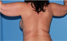 Body Contouring Before Photo by Siamak Agha, MD PhD FACS; ,  - Case 44141