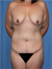 Body Contouring Before Photo by Siamak Agha, MD PhD FACS; ,  - Case 44165