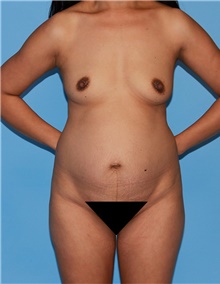 Body Contouring Before Photo by Siamak Agha, MD PhD FACS; ,  - Case 44183