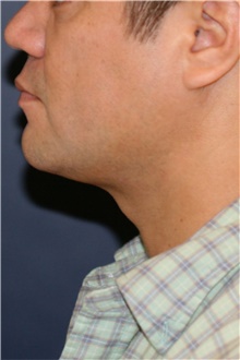Liposuction After Photo by Steve Laverson, MD, FACS; Rancho Santa Fe, CA - Case 44321