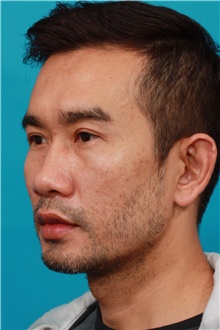 Eyelid Surgery After Photo by Michael Bogdan, MD, MBA, FACS; Grapevine, TX - Case 44364
