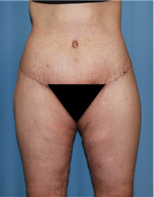 Thigh Lift After Photo by Siamak Agha, MD PhD FACS; ,  - Case 44533