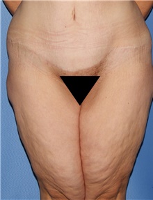 Thigh Lift Before Photo by Siamak Agha, MD PhD FACS; ,  - Case 44535