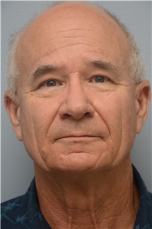 Brow Lift After Photo by Carlos Rivera-Serrano, MD; ,  - Case 44590