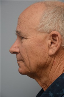 Brow Lift After Photo by Carlos Rivera-Serrano, MD; ,  - Case 44590