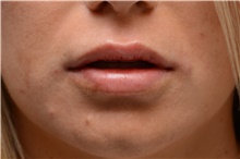 Lip Augmentation/Enhancement After Photo by Carlos Rivera-Serrano, MD; ,  - Case 44609