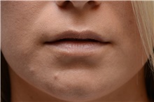 Lip Augmentation/Enhancement Before Photo by Carlos Rivera-Serrano, MD; ,  - Case 44609