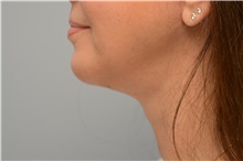 Chin Augmentation After Photo by Carlos Rivera-Serrano, MD; ,  - Case 44615