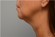 Chin Augmentation Before Photo by Carlos Rivera-Serrano, MD; ,  - Case 44615