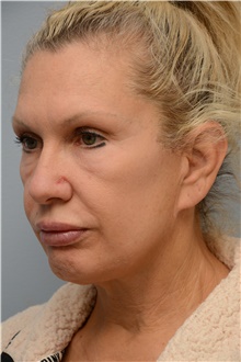 Facelift Before Photo by Carlos Rivera-Serrano, MD; ,  - Case 44616