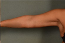 Arm Lift After Photo by Ellen Janetzke, MD; ,  - Case 44650
