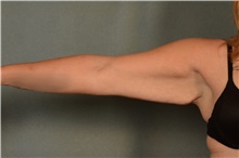 Arm Lift Before Photo by Ellen Janetzke, MD; ,  - Case 44650