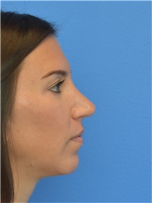 Rhinoplasty After Photo by Adam Weinfeld, MD; Austin, TX - Case 44651