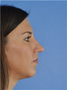 Rhinoplasty Before Photo by Adam Weinfeld, MD; Austin, TX - Case 44651